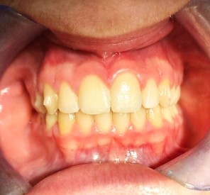 ortodonzia invisibile dopo