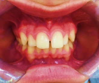 ortodonzia invisibile prima